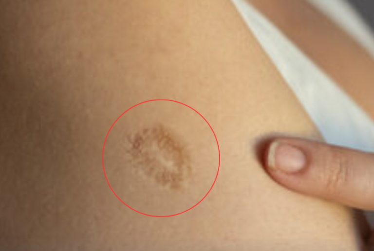 Unveiling the True Meaning Behind the Tiny Scar on Your Upper Left Arm!