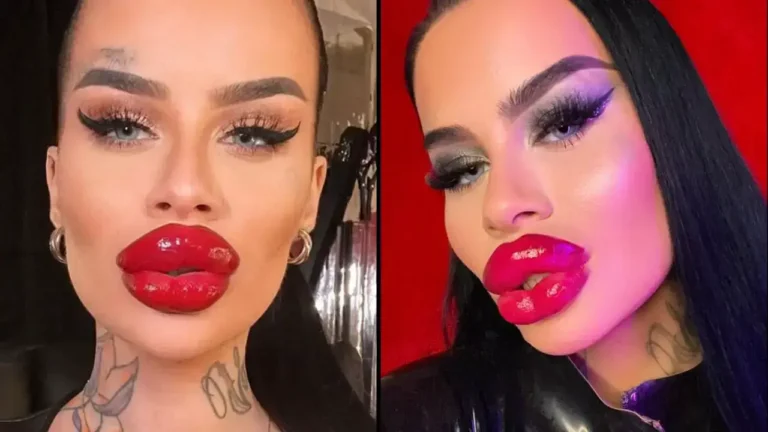 Model With Huge Lips Shows Off What She Looked Like Before Transformation