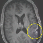 Astonishing cancer breakthrough sees woman’s brain tumor almost disappear in just five days
