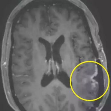 Astonishing cancer breakthrough sees woman’s brain tumor almost disappear in just five days