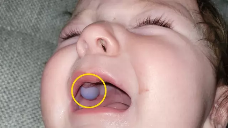 Stunned doctors thought baby had mouth tumour until discovering alarming truth