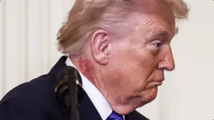 Donald Trump sparks fresh health concerns with scabbing neck rash