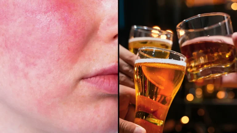 Disturbing Reason Why Some People’s Skin Turns Red When Drinking Alcohol